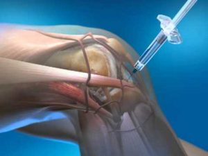 hyaluronic acid knee injections gel shots knee pain Atlantic Medical Canton
