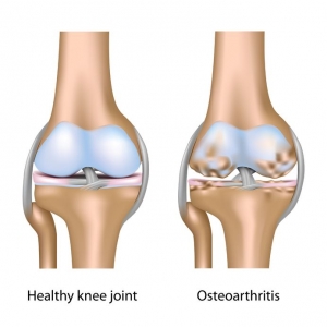 knee pain osteoarthritis Atlantic Medical Group Canton