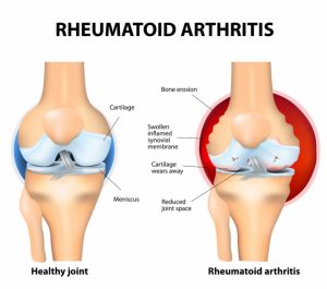 rheumatoid arthritis knee pain Atlantic Medical Group Canton