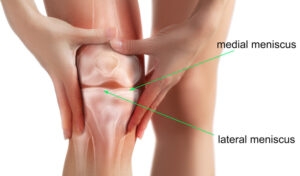 meniscus tear knee
